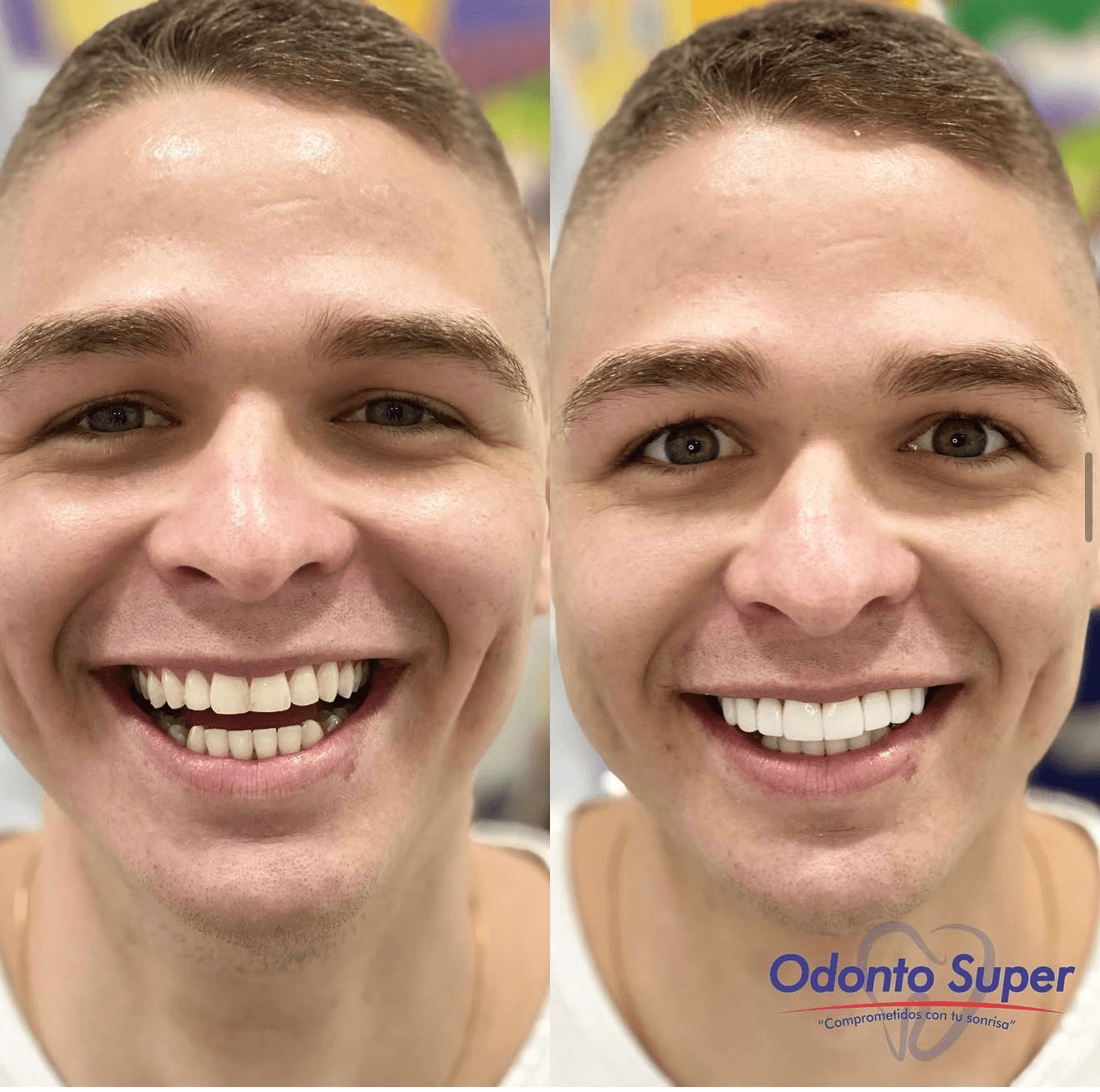 A happy Odonto Súper patient before and after his new smile